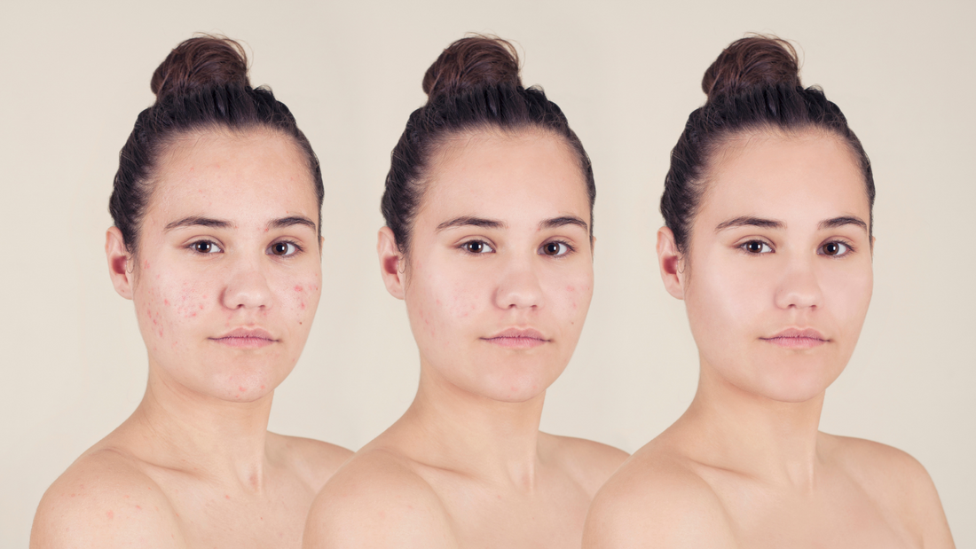 Combating Acne — Proven Methods for Clear, Healthy Skin